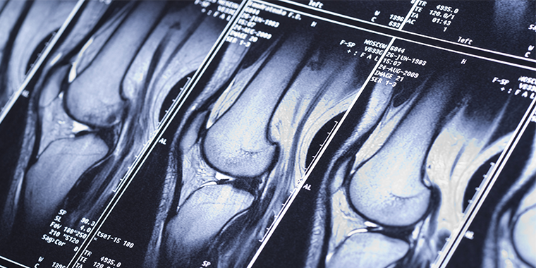 Knee MRI showing damage of cross-shaped ligaments